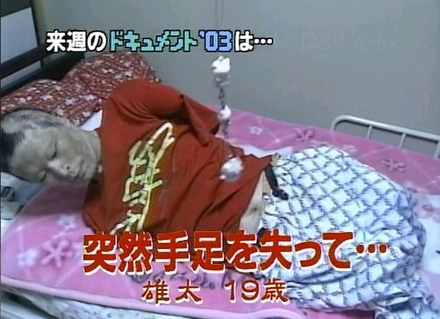 速報 突然両手足を失って 雄太 19歳 の動画うｐキタ うながんま