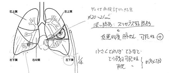 肺がん(腫瘍の場所)