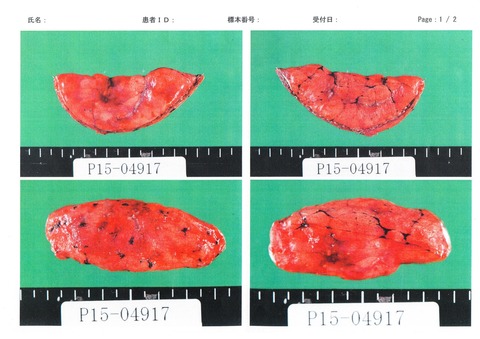 肺がん摘出部位