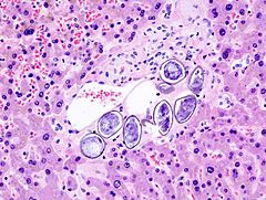 Schistosoma_japonicum_(3)_histopathology