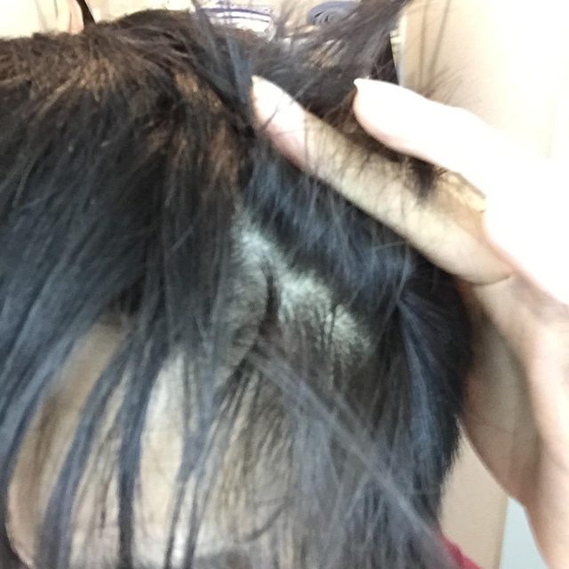 薄毛判定 あなたの薄毛を判定します 薄毛news