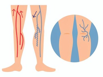 【画像】グラドルまんさん、足の血管がものすごいことになるw