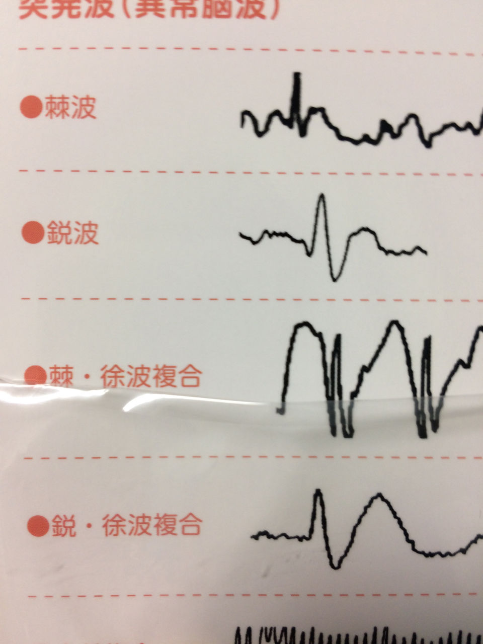脳波の読み方 準備 5 棘波と鋭波の違いはこれだ 2時間でマスターできる 精神科レジデントのための脳波の読み方