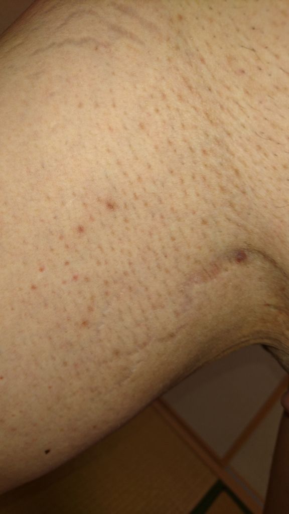 アラフィフ男性のVIO脱毛日記