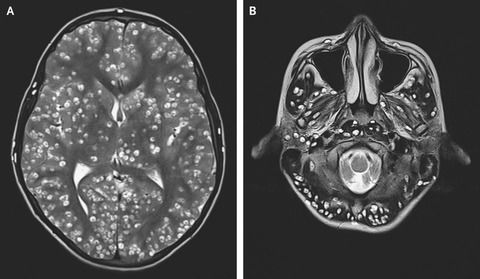 衝撃 脳内がサナダムシだらけ Mri検査で判明 インドの１８歳 閲覧注意 まとめウォッチ速報