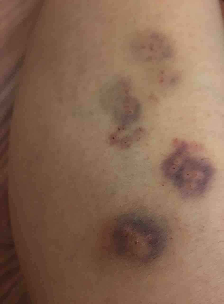 治癒記録写真 カッピング 穿刺 瘀血 瀉血 アトピー シミ 白斑 Wet Upping 日記 カッピング 穿刺 瀉血 瘀血 Wet Cupping 治癒記録写真 カッピング 穿刺 瘀血 瀉血 アトピー シミ 白斑 Wet Upping 日記 カッピング 穿刺 瀉血 瘀血 Wet Cupping
