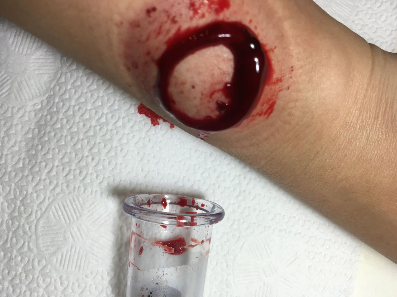 3回目 カッピング 穿刺 瘀血 瀉血 アトピー シミ 白斑 Wet Upping 日記 カッピング 穿刺 瀉血 瘀血 Wet Cupping