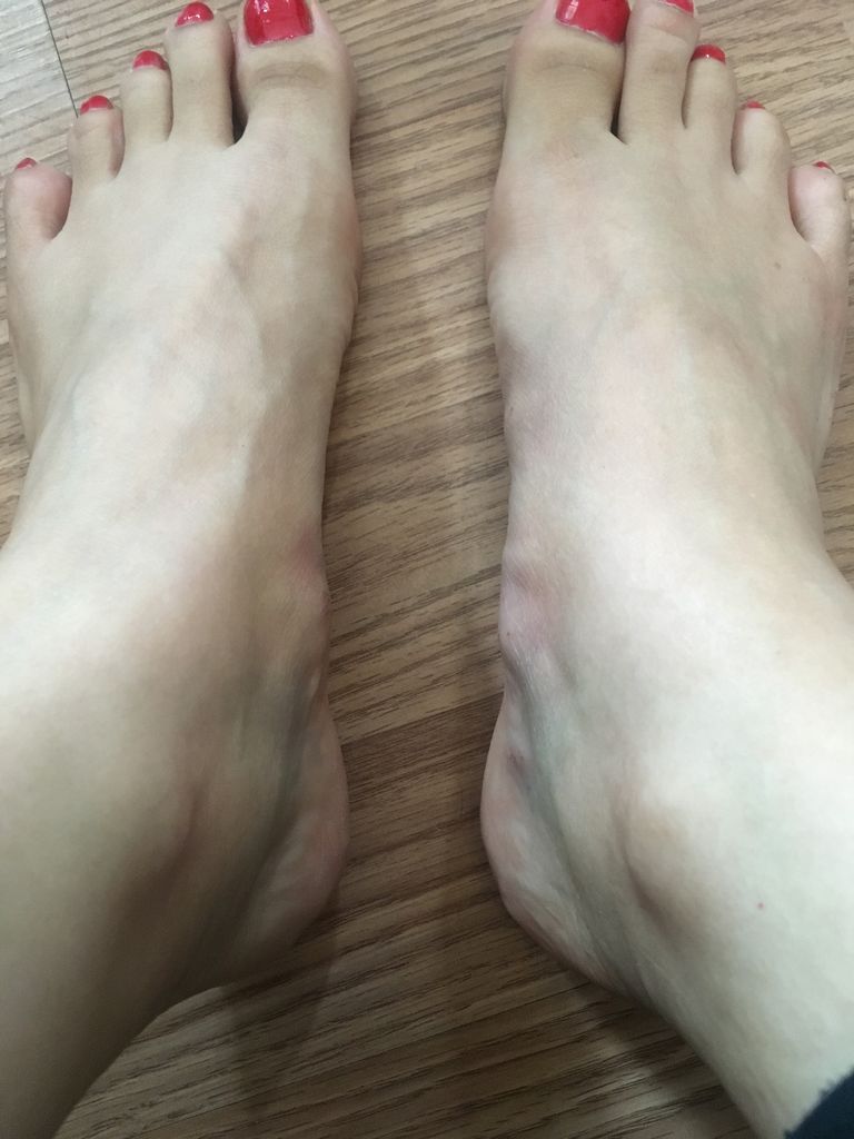 4回目 カッピング 穿刺 瘀血 瀉血 アトピー シミ 白斑 Wet Upping 日記 カッピング 穿刺 瀉血 瘀血 Wet Cupping 4回目 カッピング 穿刺 瘀血 瀉血 アトピー シミ 白斑 Wet Upping 日記 カッピング 穿刺 瀉血 瘀血 Wet Cupping