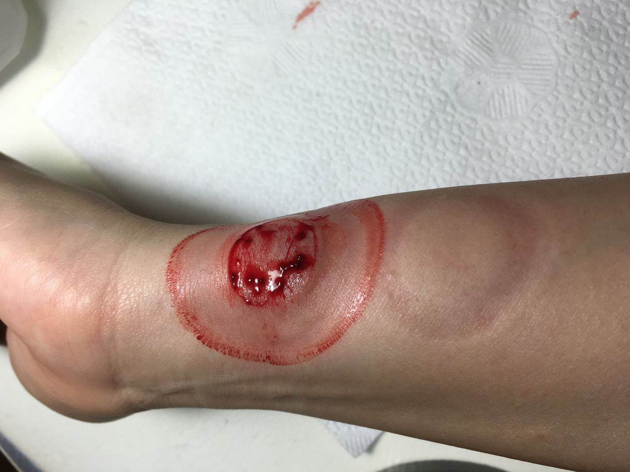 2回目 カッピング 穿刺 瘀血 瀉血 アトピー シミ 白斑 Wet Upping 日記 カッピング 穿刺 瀉血 瘀血 Wet Cupping 2回目 カッピング 穿刺 瘀血 瀉血 アトピー シミ 白斑 Wet Upping 日記 カッピング 穿刺 瀉血 瘀血 Wet Cupping