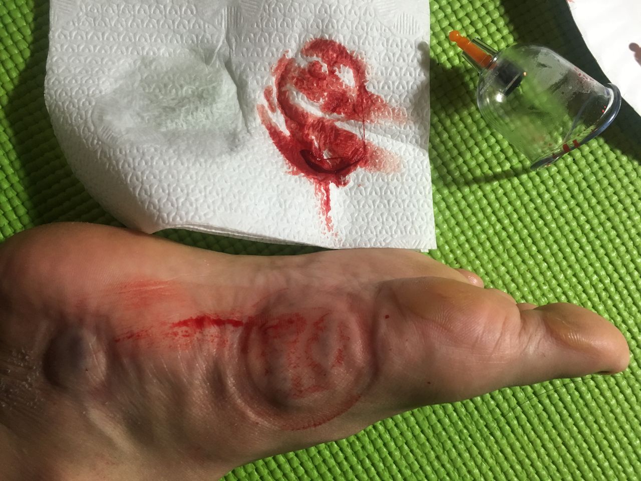 1回目 カッピング 穿刺 瘀血 瀉血 アトピー シミ 白斑 Wet Upping 日記 カッピング 穿刺 瀉血 瘀血 Wet Cupping 1回目 カッピング 穿刺 瘀血 瀉血 アトピー シミ 白斑 Wet Upping 日記 カッピング 穿刺 瀉血 瘀血 Wet Cupping