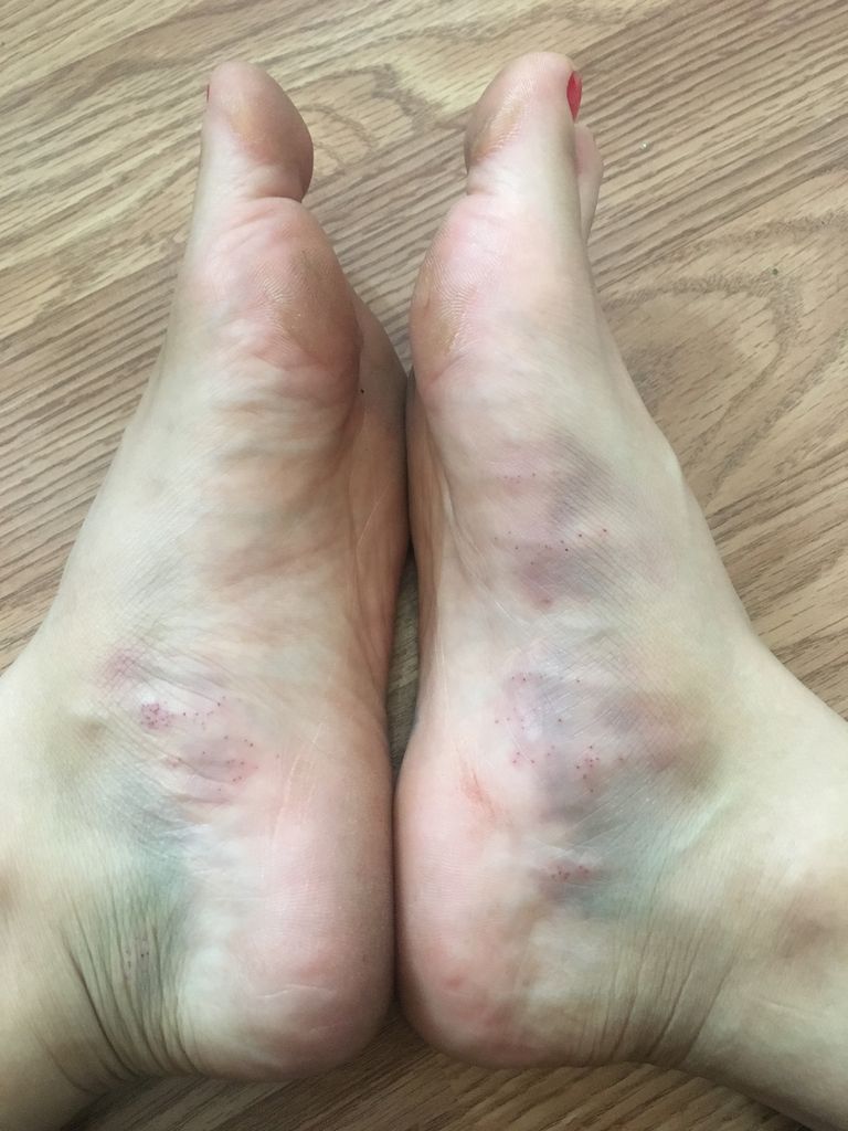4回目 カッピング 穿刺 瘀血 瀉血 アトピー シミ 白斑 Wet Upping 日記 カッピング 穿刺 瀉血 瘀血 Wet Cupping 4回目 カッピング 穿刺 瘀血 瀉血 アトピー シミ 白斑 Wet Upping 日記 カッピング 穿刺 瀉血 瘀血 Wet Cupping