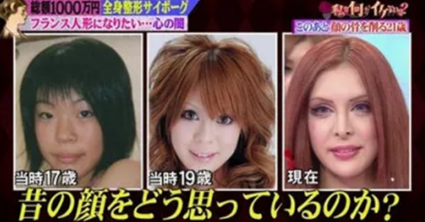 全身整形芸能人 ヴァニラ 3000万円かけ整形した前後の差が