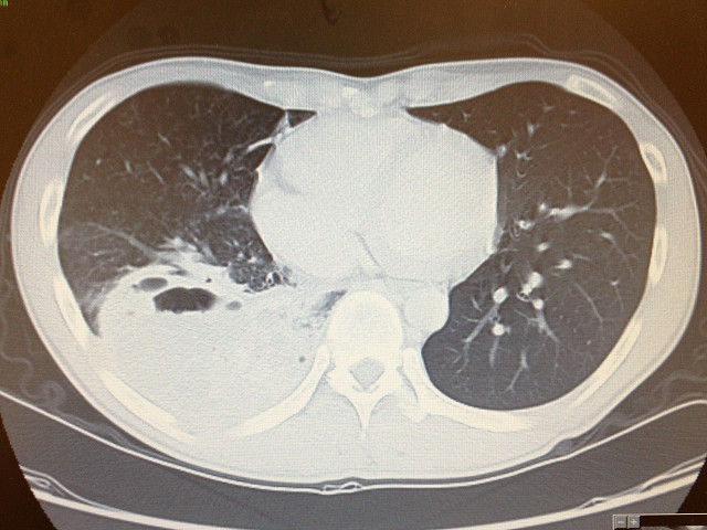 肺分画症 内科医がアジアをめざすブログ