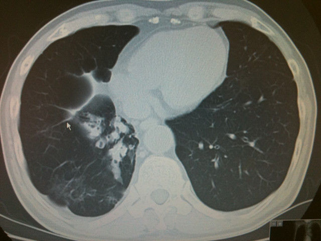 副鼻腔気管支症候群 内科医がアジアをめざすブログ