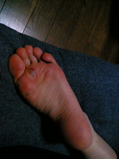 ヒールだこ 週休ゼロ日