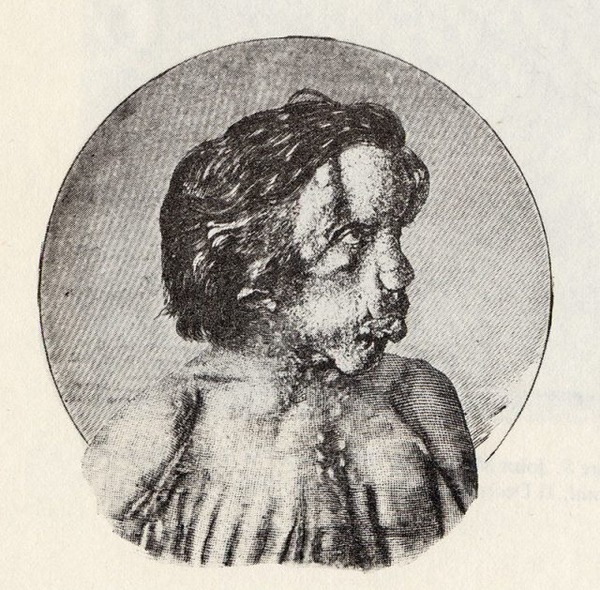 800px-joseph_merrick_1886_2-640x629