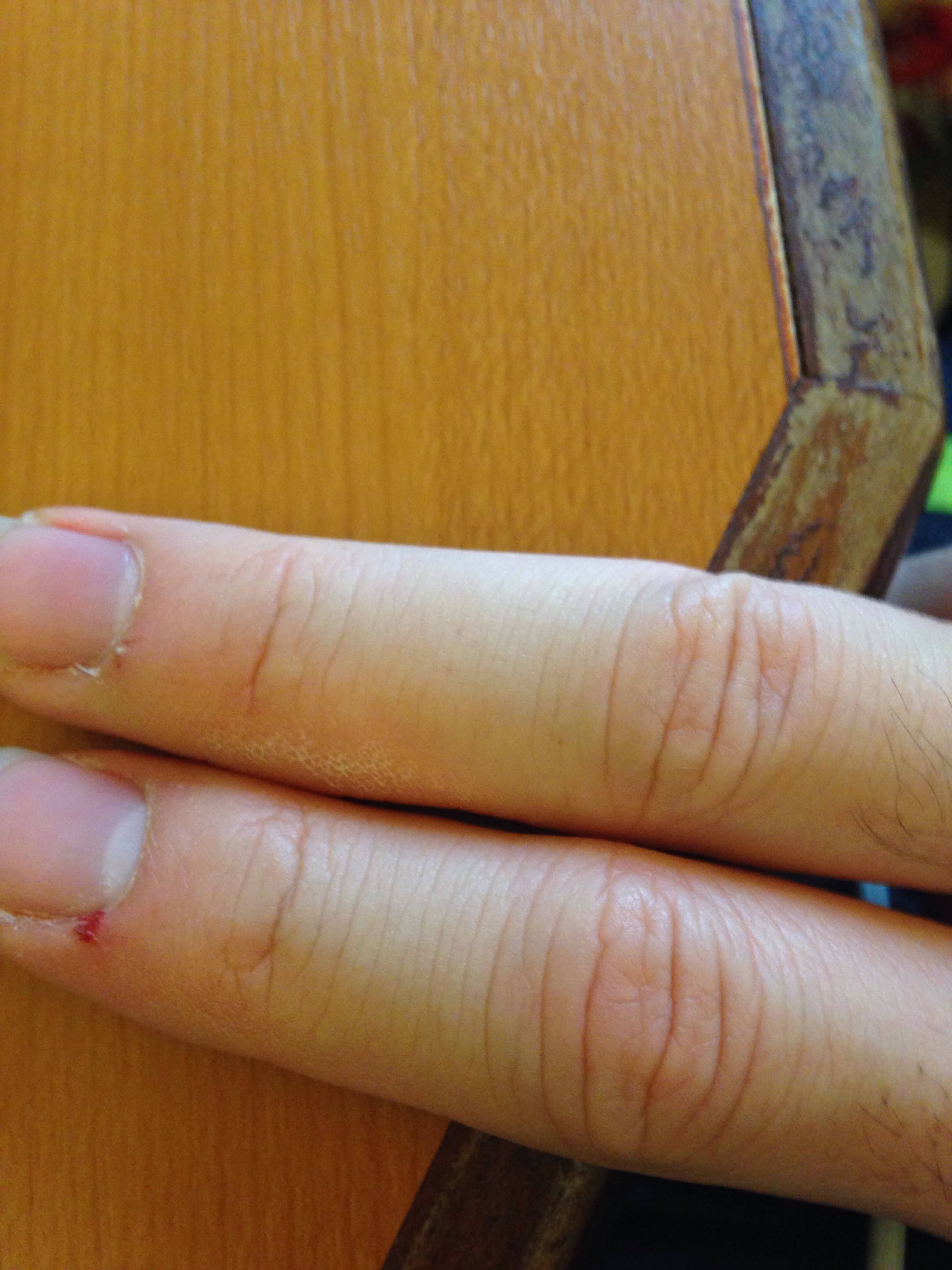 ぐっちぃ 爪のささくれから出血 これは珍しい ぐっちぃの卓球活動日記 Wrm