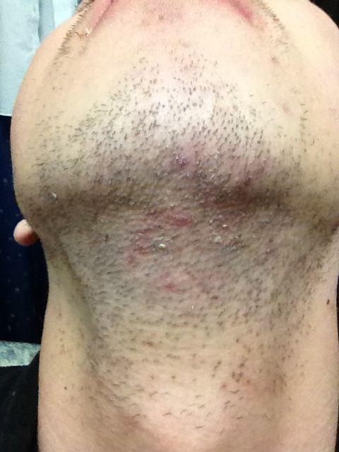 ヒゲ脱毛 メンズ脱毛のまとめ 脱毛 情報館 美容 エステ スキンケア ヒゲ脱毛 メンズ脱毛のまとめ 脱毛 情報館 美容 エステ スキンケア