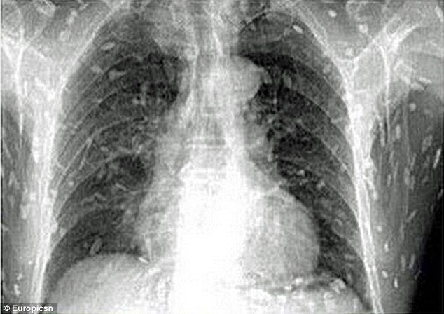 寿司好き男性の体に寄生虫がびっしり 生魚が原因か 写真あり 2ちゃんまとめ 2chまとめ 2ちゃんねるまとめ 過去ログも 寿司好き男性の体に寄生虫がびっしり 生魚が原因か 写真あり 2ちゃんまとめ 2chまとめ 2ちゃんねるまとめ 過去ログも