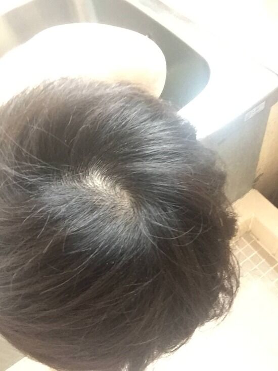 画像 わい 女からつむじハゲと言われ泣くｗｗｗｗｗｗｗｗ ワイ速
