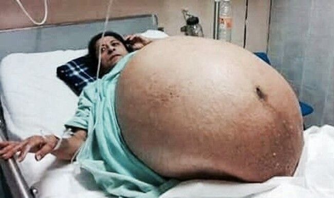 やばたんまとめ 閲覧注意 11人の子供を一度に妊娠した女性 そのお腹がヤバすぎる Livedoor Blog ブログ