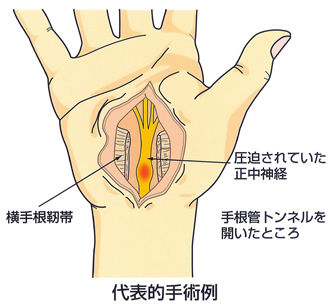手指のしびれ 手根管症候群 でお悩みの方へ 整形外科 八幡病院のblog 手指のしびれ 手根管症候群 でお悩みの方へ 整形外科 八幡病院のblog