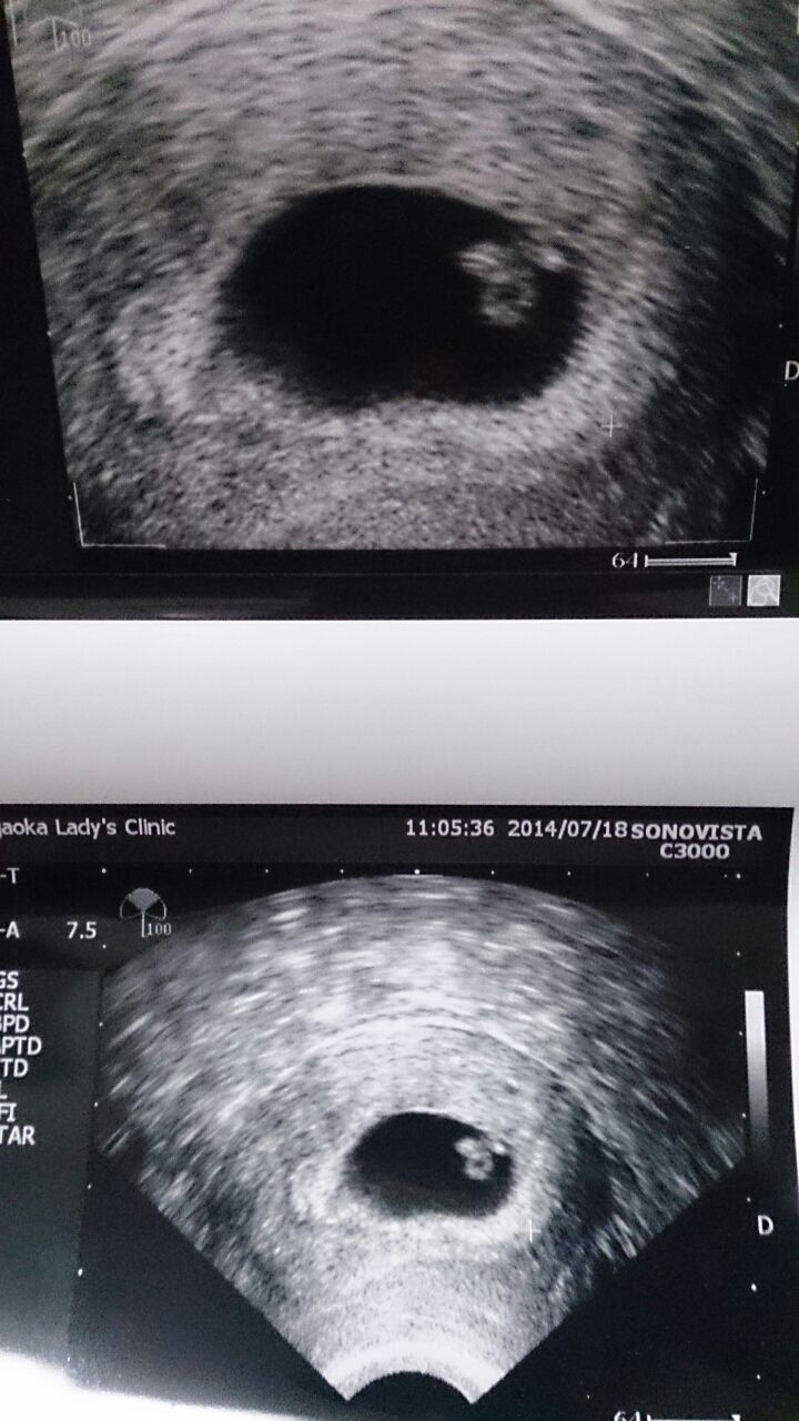 妊娠初期記録 6 8w エコー写真あり 20代で体外受精にステップアップ 妊娠 切迫早産