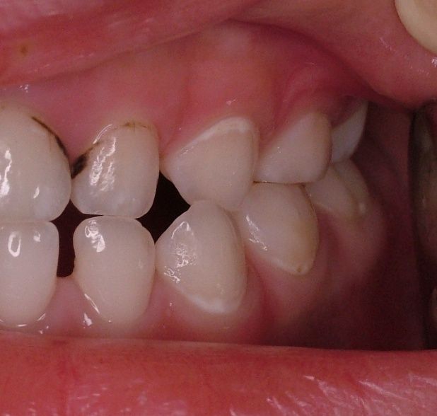 やまわき歯科医院の診療つれづれ日記初期のむし歯