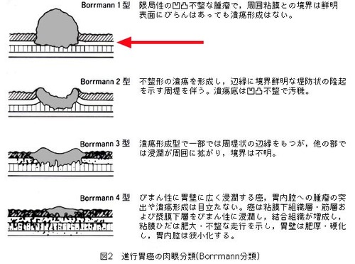 ボール マン 分類