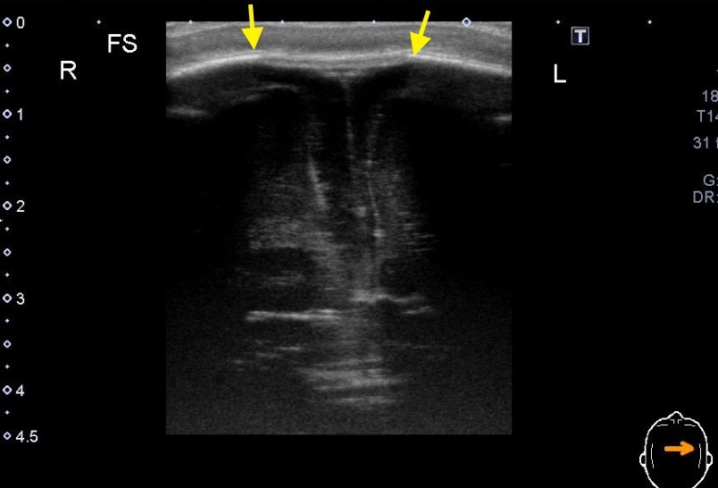 頭位性斜頭でのエコー Yanchangの現在修行中