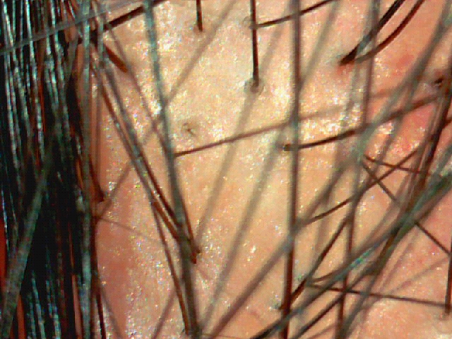 中年サラリーマンの育毛日記 : 頭皮写真 - livedoor Blog（ブログ）