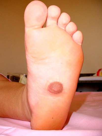 third-nipple-found-on-womans-foot-31360-1311010178-23
