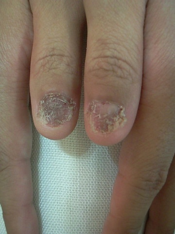 img-nailproblem1