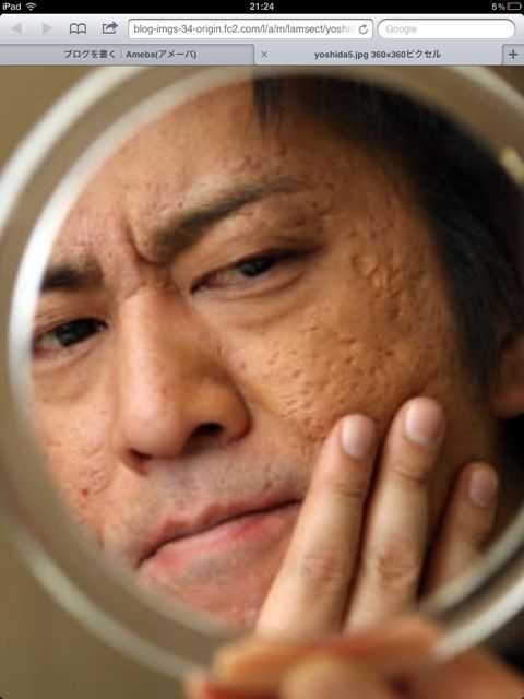 ニキビ跡大量で人生ベリーハード 新生やせ速報