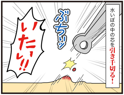 水いぼ治療4