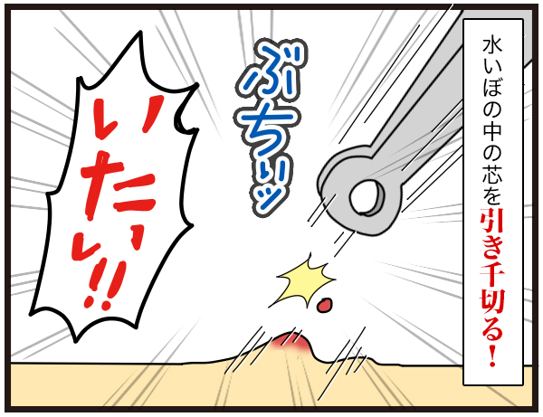 水いぼ治療 ダンナ様は安月給 Powered By ライブドアブログ