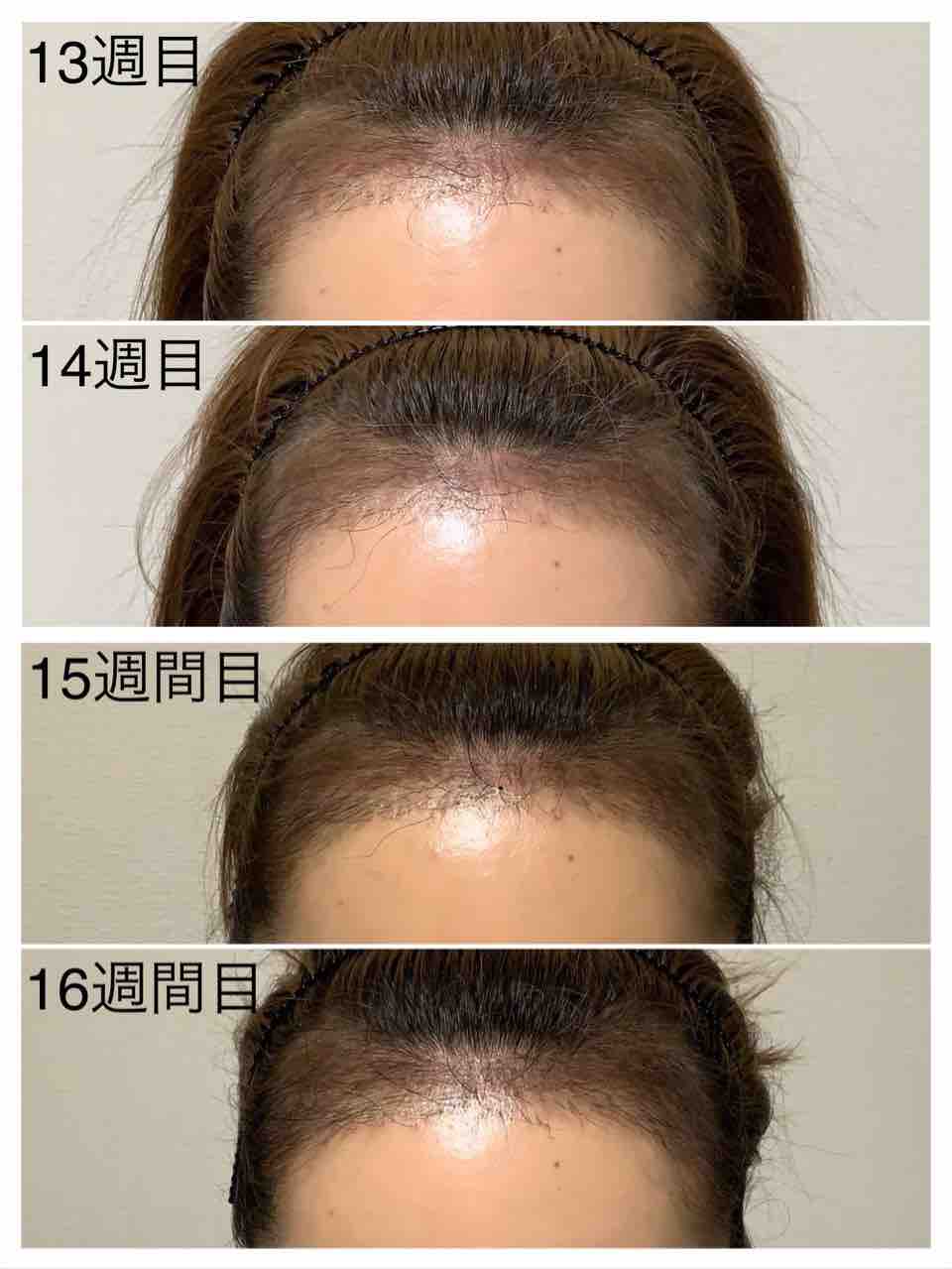 13週目 16週目 女性のヘアライン矯正 13週目 16週目 女性のヘアライン矯正