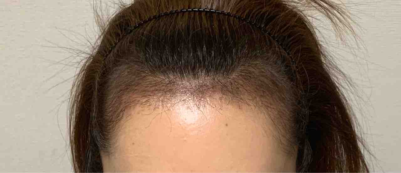 術後2ヶ月 女性のヘアライン矯正 術後2ヶ月 女性のヘアライン矯正