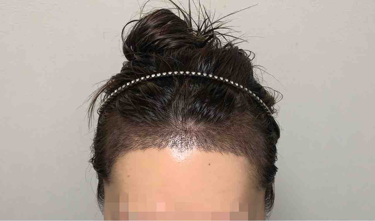 術後3週間 女性のヘアライン矯正 術後3週間 女性のヘアライン矯正