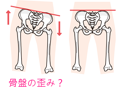骨盤の歪み