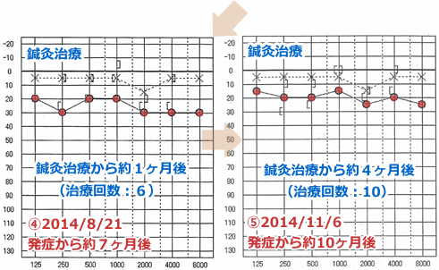 鍼灸院での突発性難聴の症例(オージオグラム2) hspace=