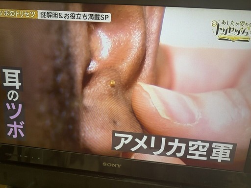 戦場鍼(NHK/ツボのトリセツ)