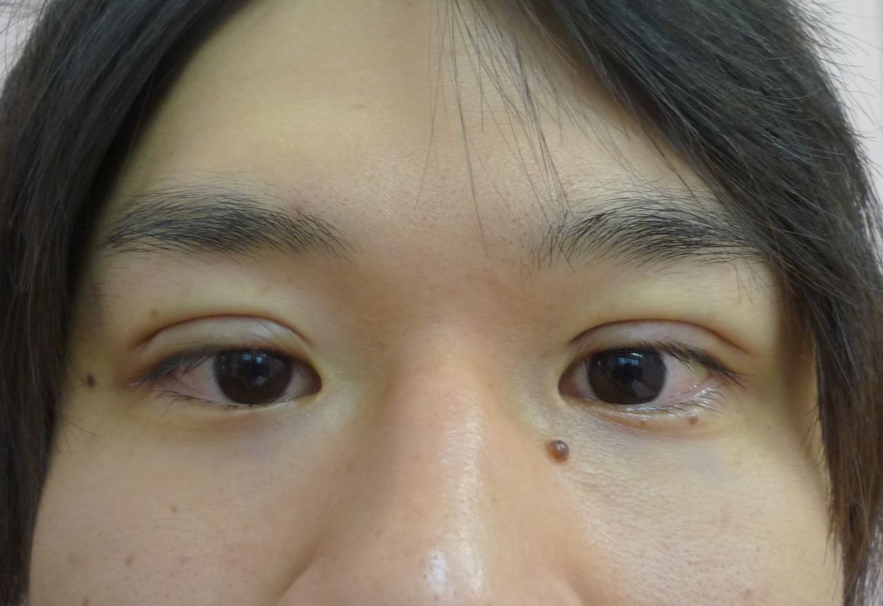 平行型二重になりたい 横浜で働く美容外科院長の美容整形ここだけの話ブログ