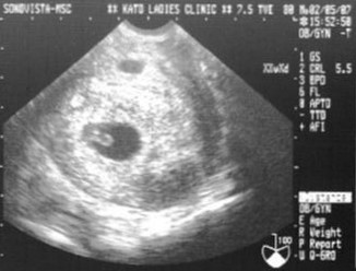 ６ｗ４ｄ ｂｔ２７日目 心拍確認 ３６歳からの子づくり