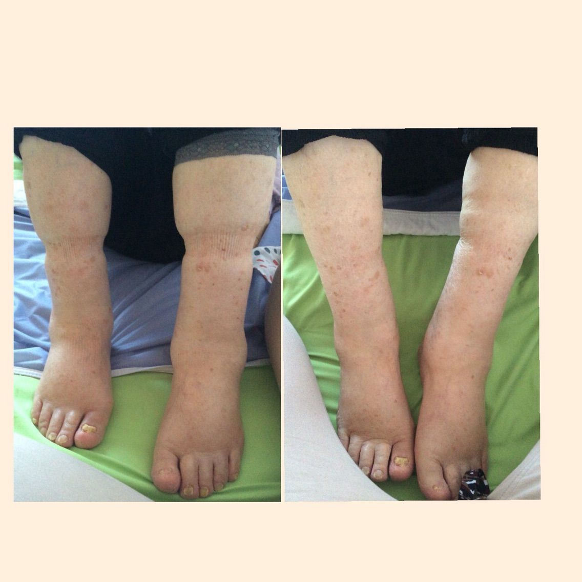 ビフォーアフター 足の浮腫 鍼灸指圧マッサージ 真心堂 ビフォーアフター 足の浮腫 鍼灸指圧マッサージ 真心堂