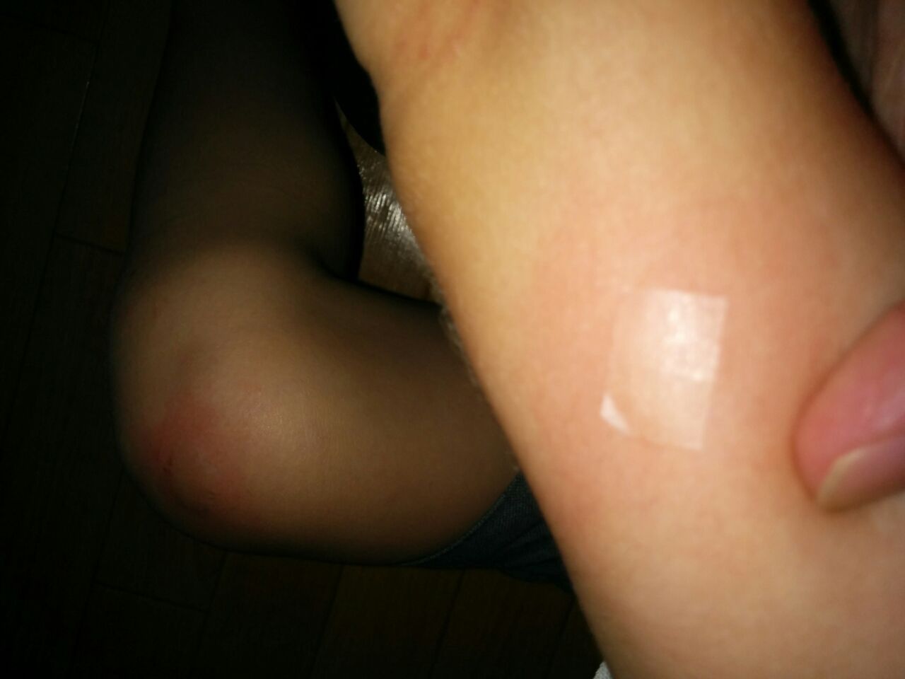 子どもの虫刺され対処方 かき壊しなし 元教師のわくわく家庭学習