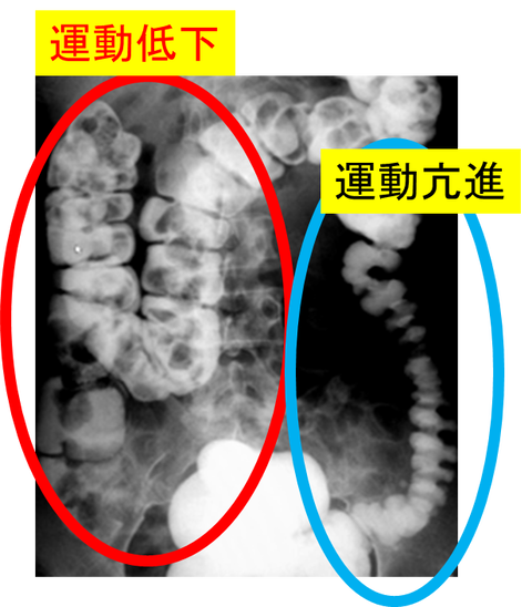 IBS