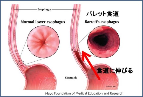バレット