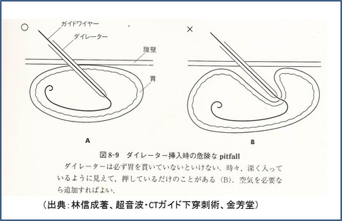 胃瘻０