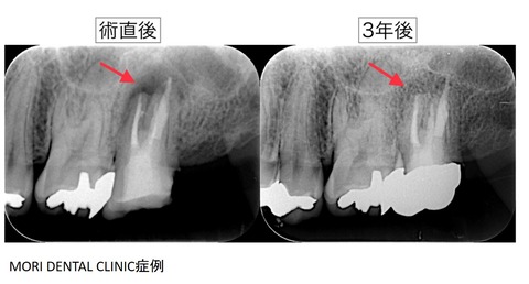 歯根